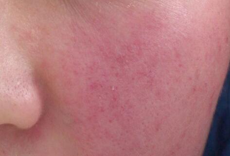 如何拯救你的敏感??？廣西南寧美容培訓(xùn)叫你正確方法