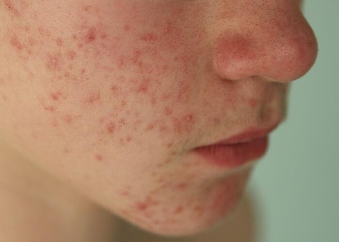 粉刺閉口應(yīng)該如何處理？