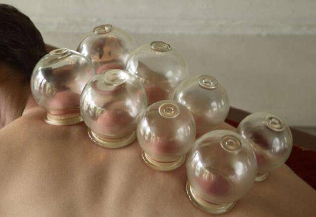 南寧美容培訓(xùn)課程：拔罐后的罐印顏色代表什么