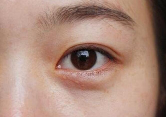 黑眼圈的種類有哪些？廣西美容培訓(xùn)教你保養(yǎng)