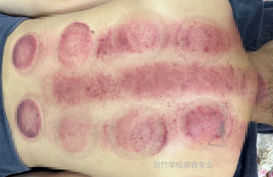 拔火罐的顏色代表什么？南寧美容美體專業(yè)實訓(xùn)