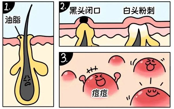 不同部位閉口形成的原因，南寧美容護膚學校解答