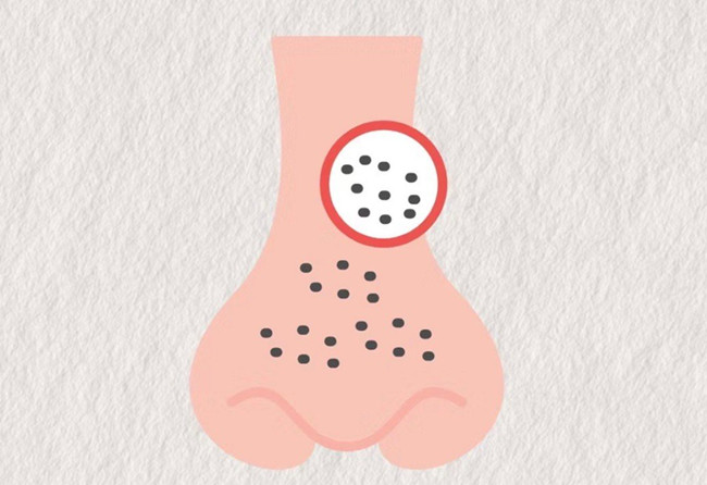 廣西皮膚管理師：面對嚴(yán)重的黑頭應(yīng)該怎么辦？